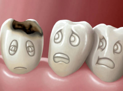В Волгодонске стоматолог по ошибке вырвала ребенку два здоровых зуба вместо одного больного