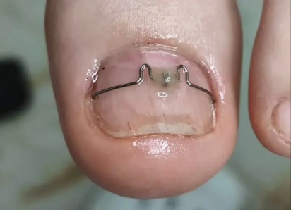 Ногти врастают и причиняют боль: почему каждому стоит посетить подолога 