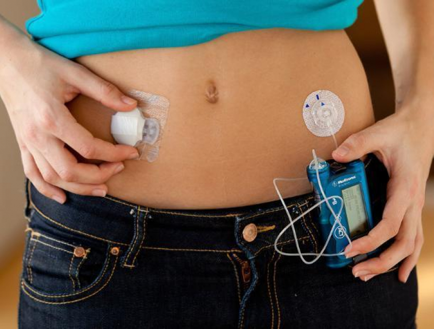 В Волгодонске расходные материалы для инсулиновых помп диабетикам будут выдавать бесплатно