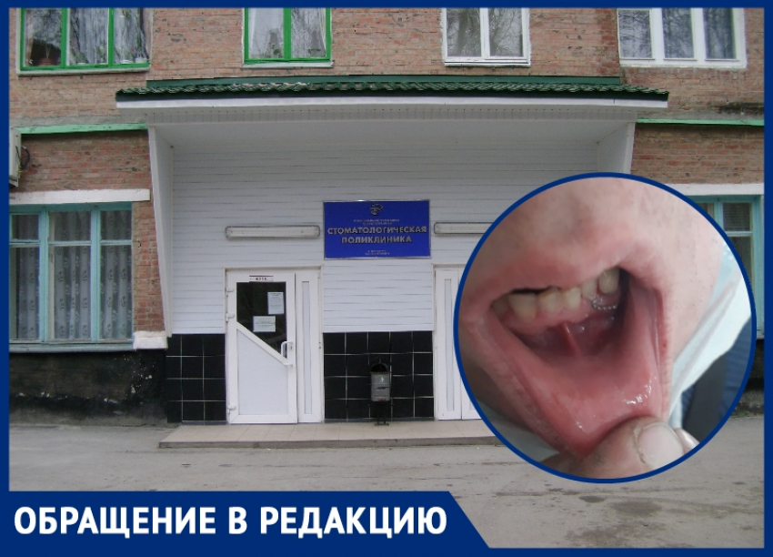 Мужчине вставили на место вырванный по ошибке здоровый зуб в стоматологии Волгодонска